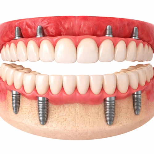 All-on-4 Dental Implants